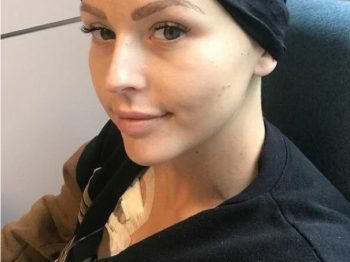 Αρνήθηκαν να της κάνουν μαστογραφία γιατί ήταν «πολύ νέα», 8 μήνες αργότερα διαγνώστηκε με καρκίνο 4ου σταδίου