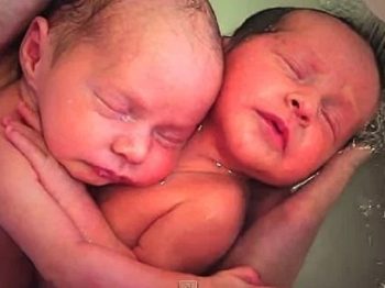 Δίδυμα δεν κατάλαβαν ότι γεννήθηκαν και μένουν αγκαλιασμένα όπως ήταν στην κοιλιά της μαμάς τους