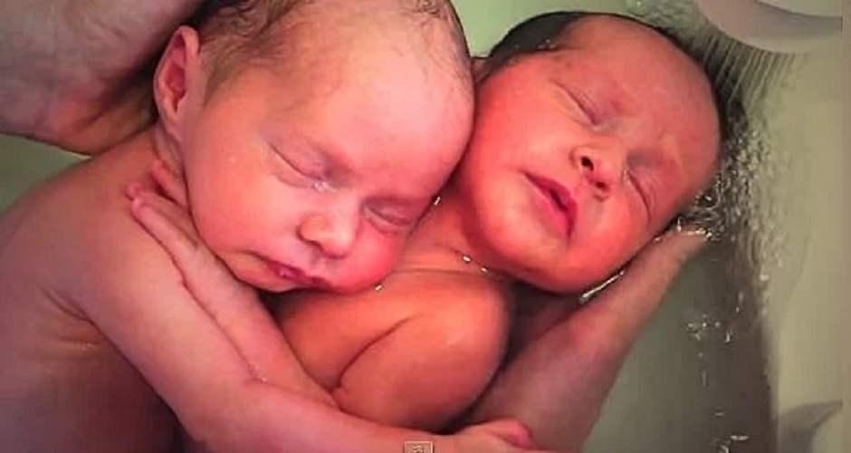 Δίδυμα δεν κατάλαβαν ότι γεννήθηκαν και μένουν αγκαλιασμένα όπως ήταν στην κοιλιά της μαμάς τους