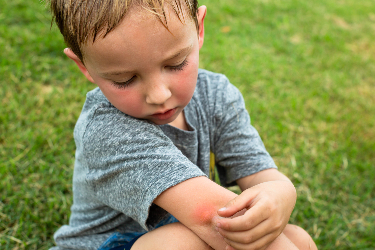 Πώς προστατεύουμε τα παιδιά από τα κουνούπια; Tips για φυσική αντιμετώπιση των τσιμπημάτων